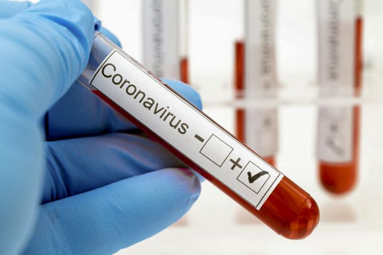 Azərbaycanda daha 590 nəfər koronavirusa yoluxdu, 7 nəfər dünyasını dəyişdi